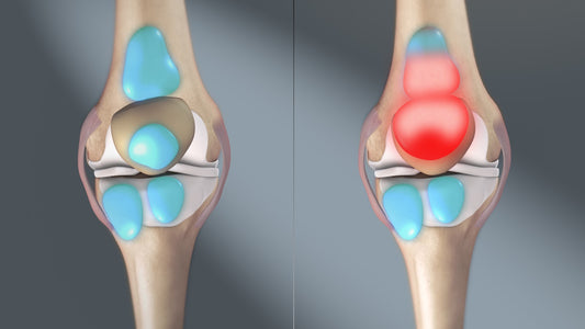 A Breakdown of Foot Bursitis and How Orthotics Can Help