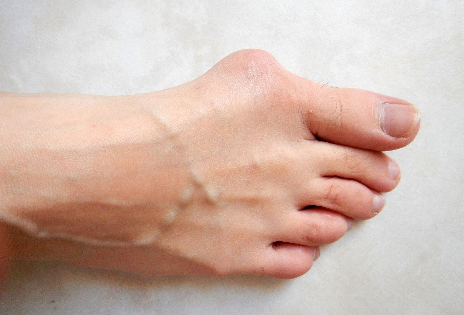 Yes, You Can Treat Bunions Without Going Under the Knife Orthotics Direct