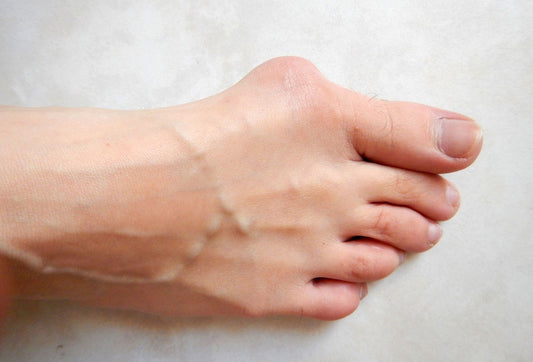 Yes, You Can Treat Bunions Without Going Under the Knife